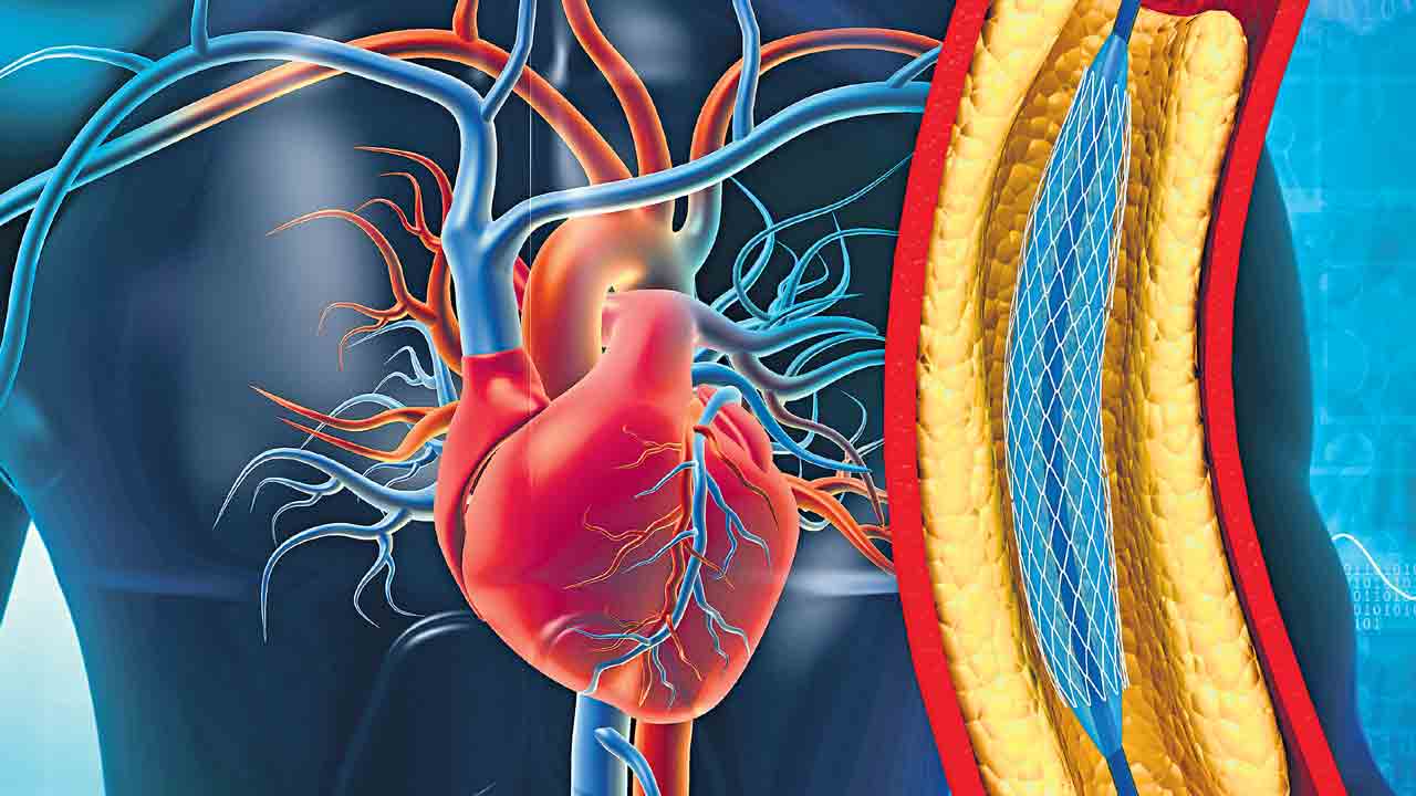 బైపాస్‌కు భయపడొద్దు.. గుండె భద్రతే ముఖ్యం