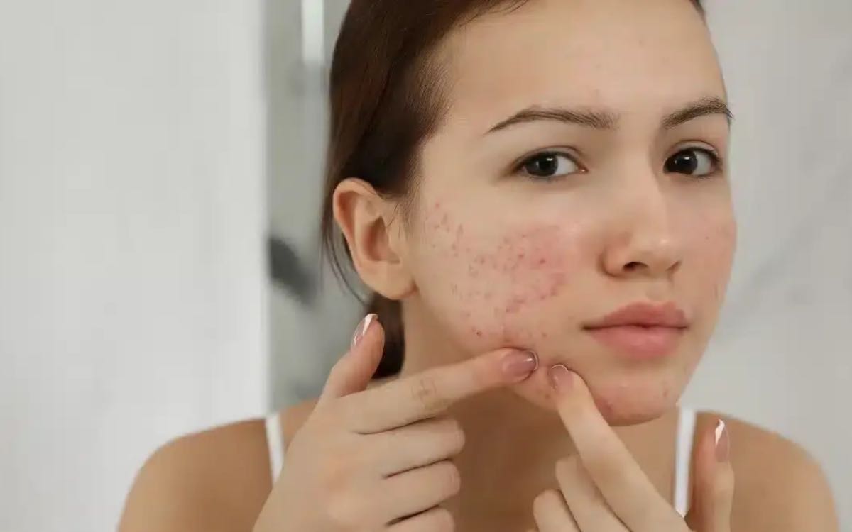Acne | అస‌లు మ‌న‌కు మొటిమ‌లు ఎందుకు వ‌స్తాయి..? అవి ఏర్ప‌డ‌డానికి కార‌ణాలు ఏమిటి..?