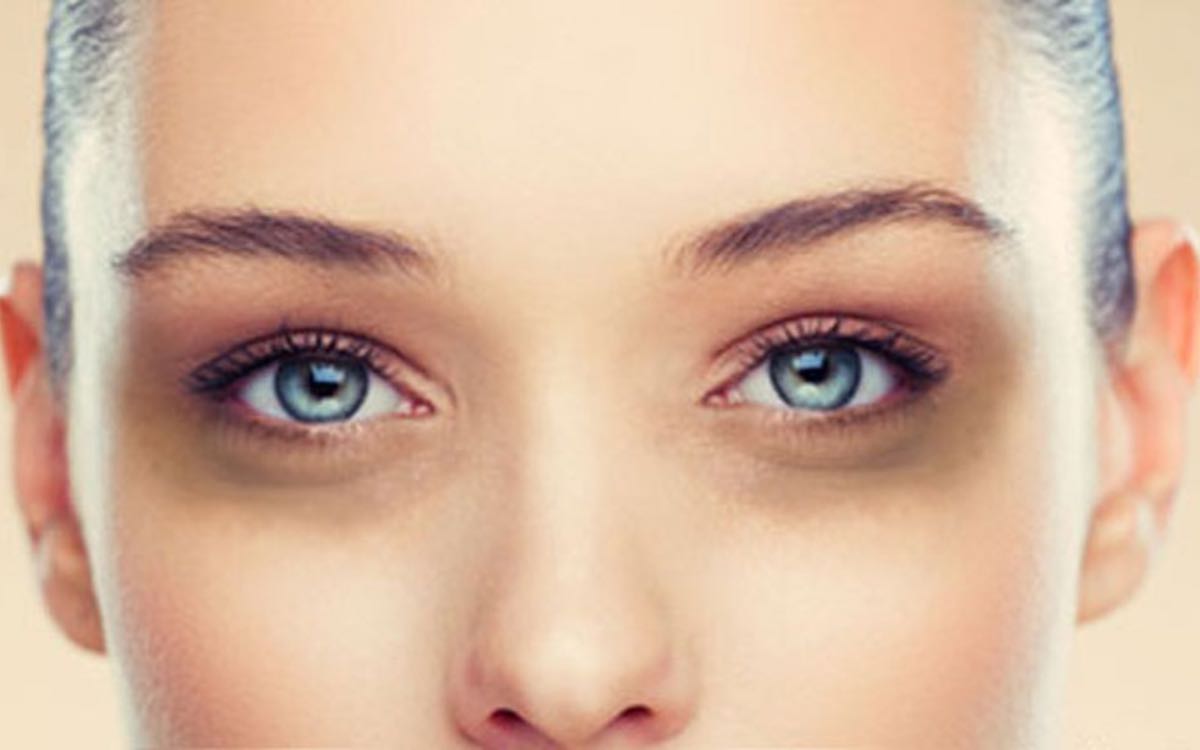 Dark Circles | క‌ళ్ల కింద ఏర్ప‌డే న‌ల్ల‌ని వ‌ల‌యాలు.. డార్క్ స‌ర్కిల్స్‌ను ఇలా సింపుల్ చిట్కాల‌తో త‌గ్గించుకోవ‌చ్చు..!