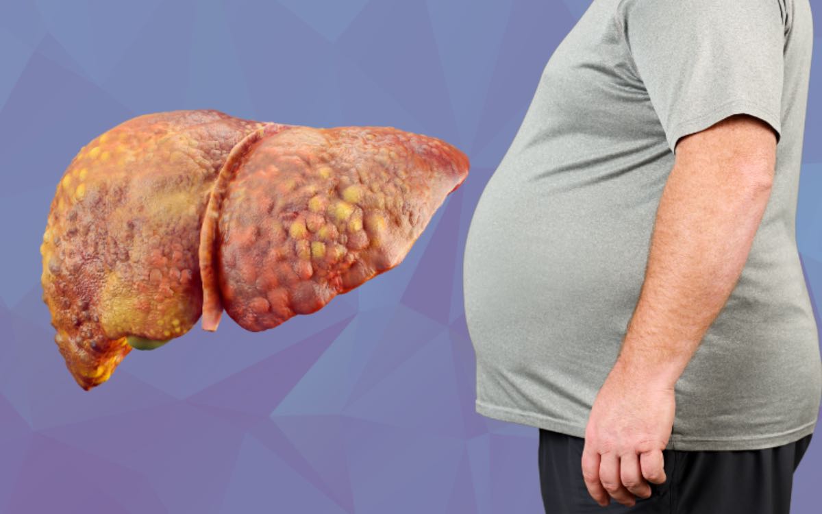 Fatty Liver Symptoms | ఫ్యాటీ లివ‌ర్ స‌మ‌స్య ఉన్న‌వారిలో క‌నిపించే ల‌క్ష‌ణాలు ఇవే.. ఇలా జ‌రుగుతుంటే జాగ్ర‌త్త‌..!