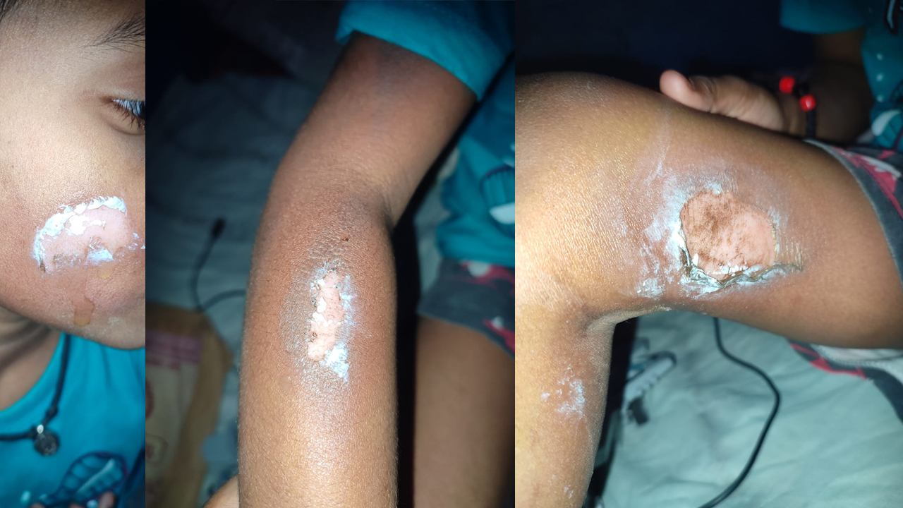 Tuition Teacher | అట్లకాడతో వాతలు.. చిన్నారిపై ట్యూషన్ టీచర్ దాష్టీకం