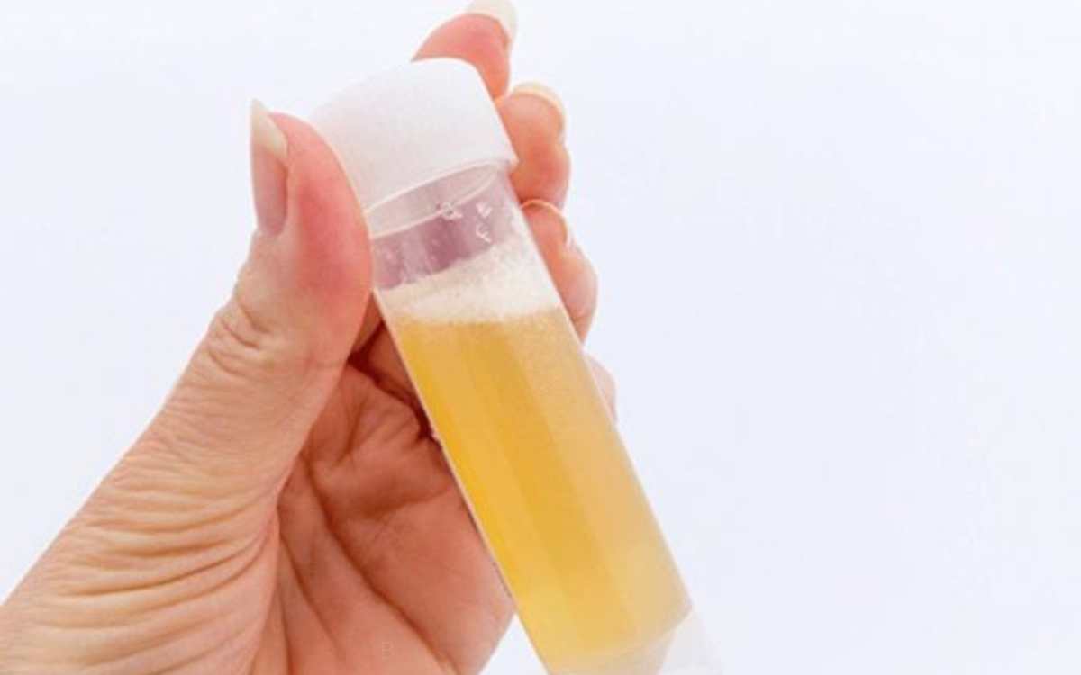 Foam In Urine | మూత్రంలో నురుగు వ‌స్తుందా..? అయితే అందుకు కార‌ణాలు ఇవే.. జాగ్ర‌త్త‌గా ఉండాల్సిందే..!