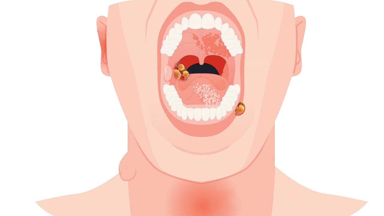 క్యాన్సర్‌ కోరలు