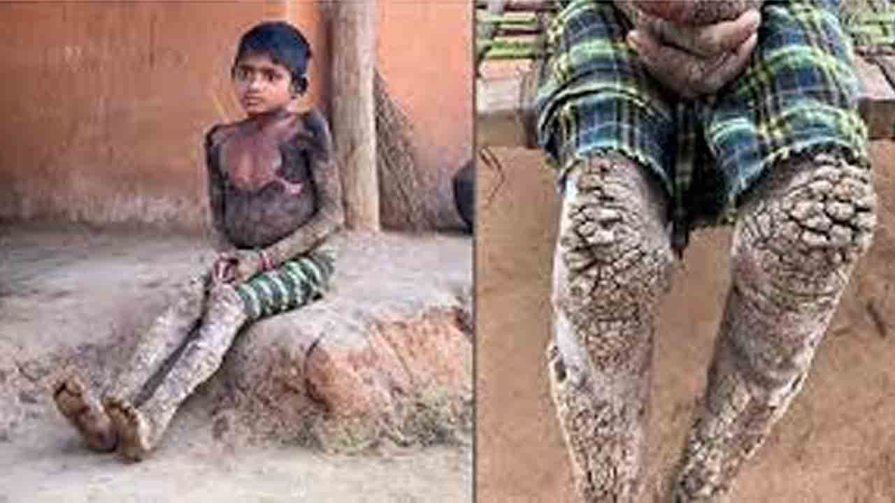 Genetic disorder | బాలికకు అరుదైన చర్మ వ్యాధి.. రాయిలా, చెట్టు బెరడులా మారుతున్న శరీరం..!