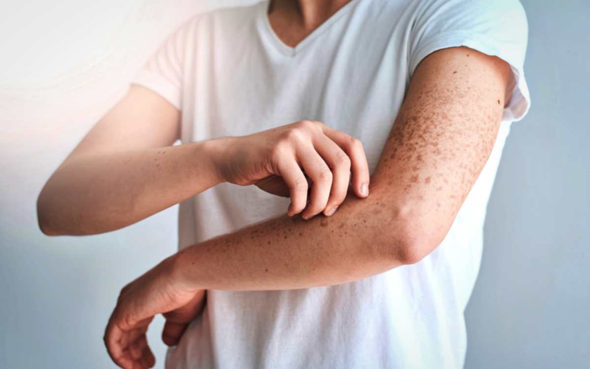 Skin Itching | చ‌ర్మంపై ఆయా భాగాల్లో దుర‌ద ఉందా..? అయితే ఈ చిట్కాల‌ను పాటించండి..!