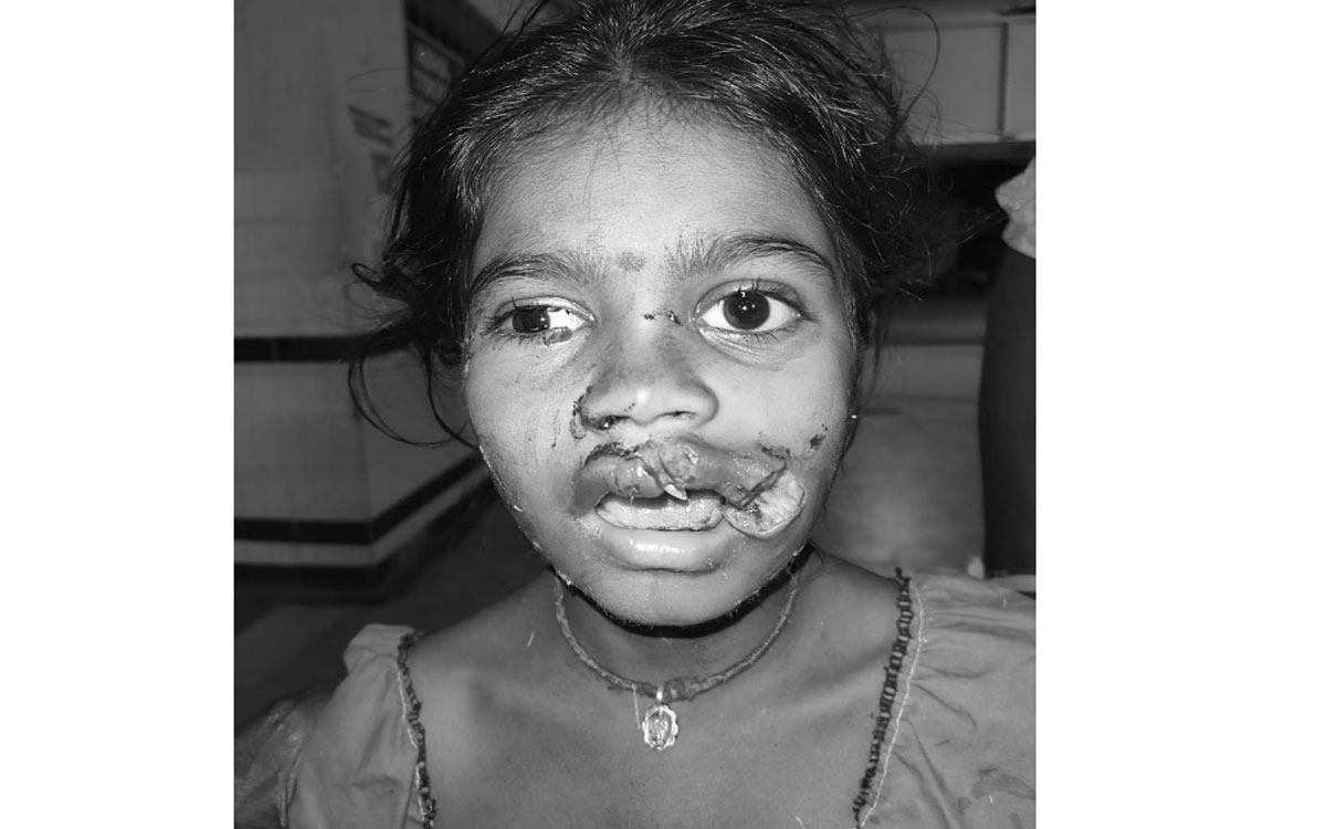 Penpahad : వీధి కుక్కల దాడిలో బాలికకు తీవ్ర గాయాలు