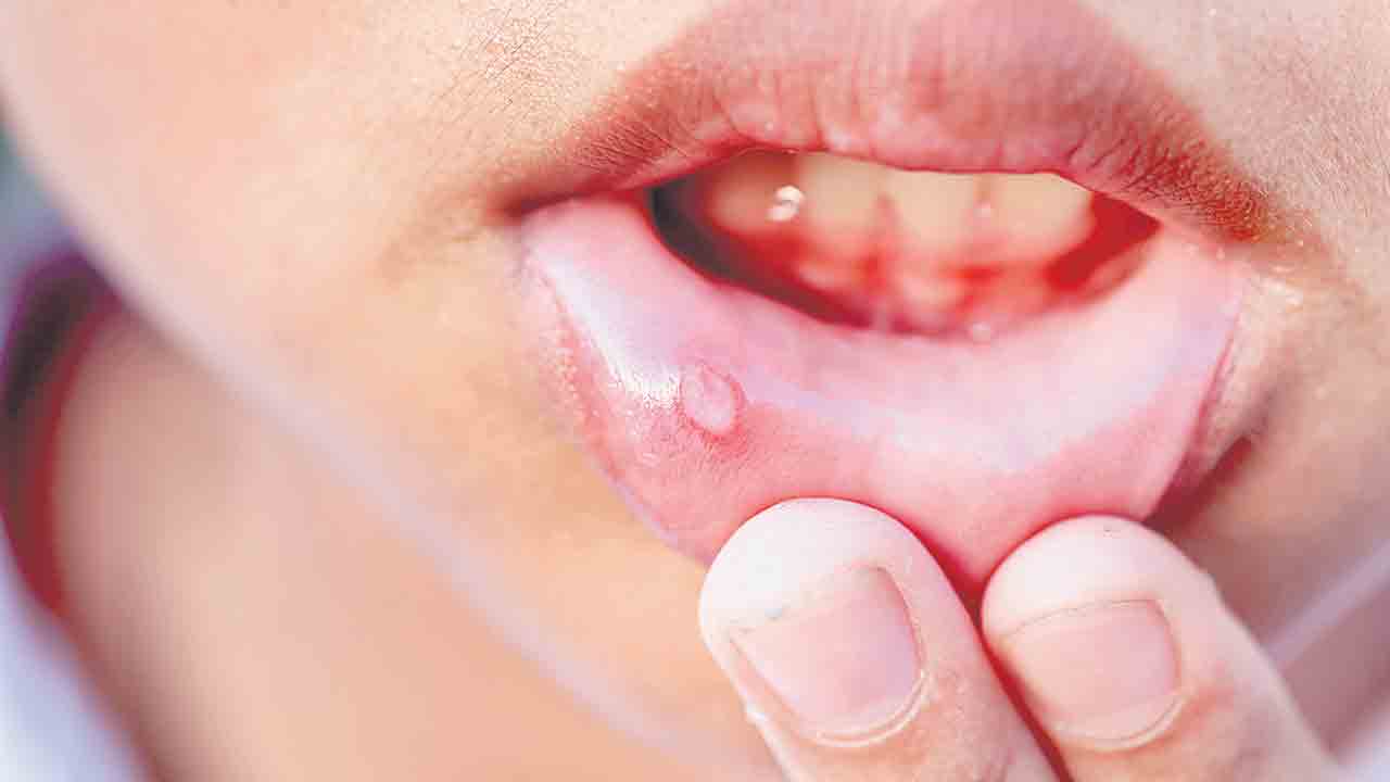 నోటి అల్సర్లకు ఇంట్లోనే చెక్‌!