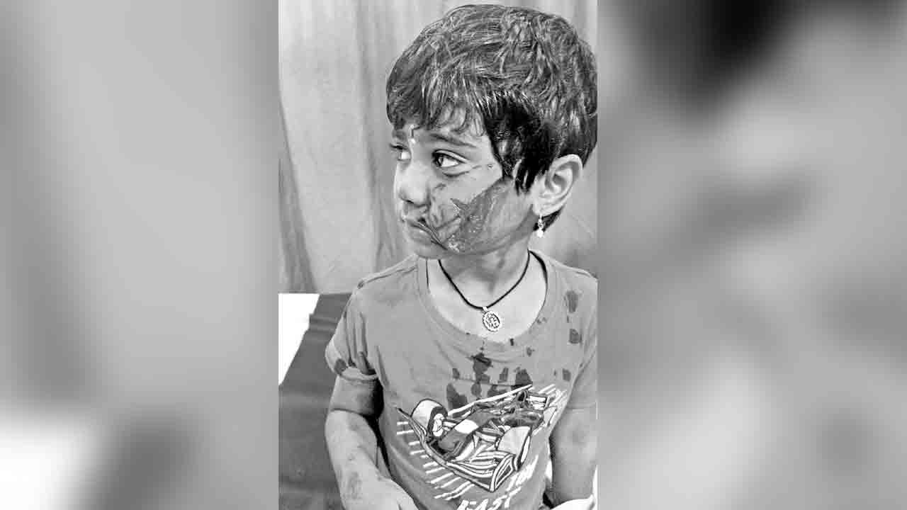 చిన్నారిపై కుక్క దాడి