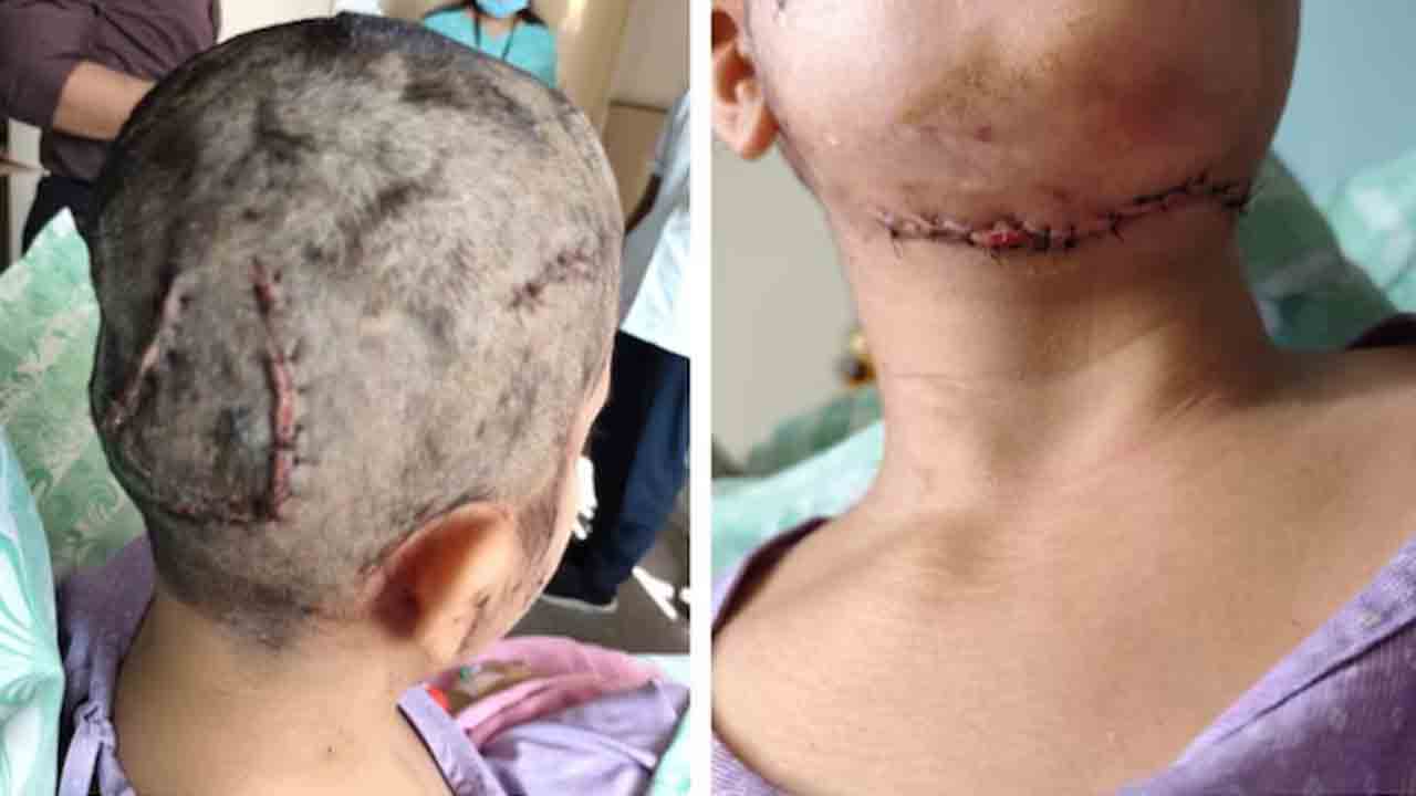 50 Stitches On Face, Neck, 