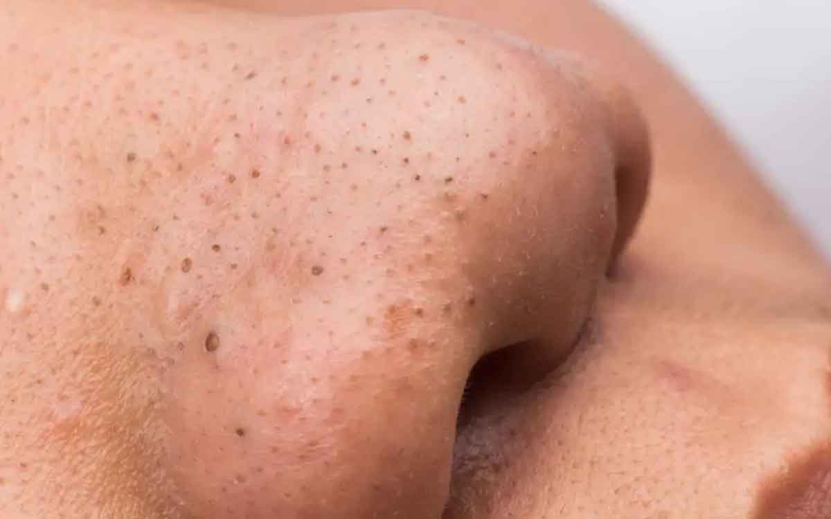 Blackheads | బ్లాక్ హెడ్స్ స‌మ‌స్య‌తో ఇబ్బందులు ప‌డుతున్నారా..? అయితే ఈ నాచుర‌ల్ చిట్కాల‌ను పాటించండి..!