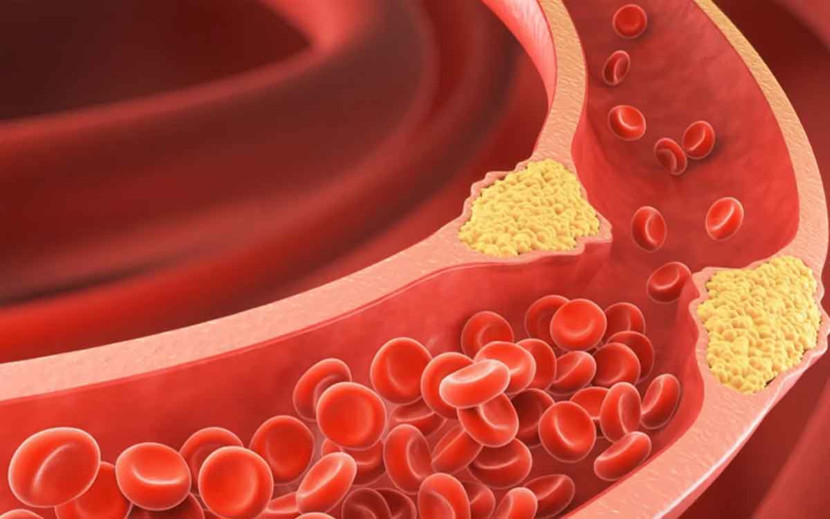 High Cholesterol | అధికంగా కొలెస్ట్రాల్ స‌మ‌స్య‌తో బాధ‌ప‌డుతున్నారా..? అయితే ఈ ఆహారాల‌ను తీసుకోకూడ‌దు..