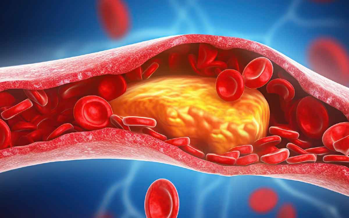 High Cholesterol | అధిక కొలెస్ట్రాల్‌తో ఇబ్బందులు ప‌డుతున్నారా..? అయితే ఇలా చేయండి..!