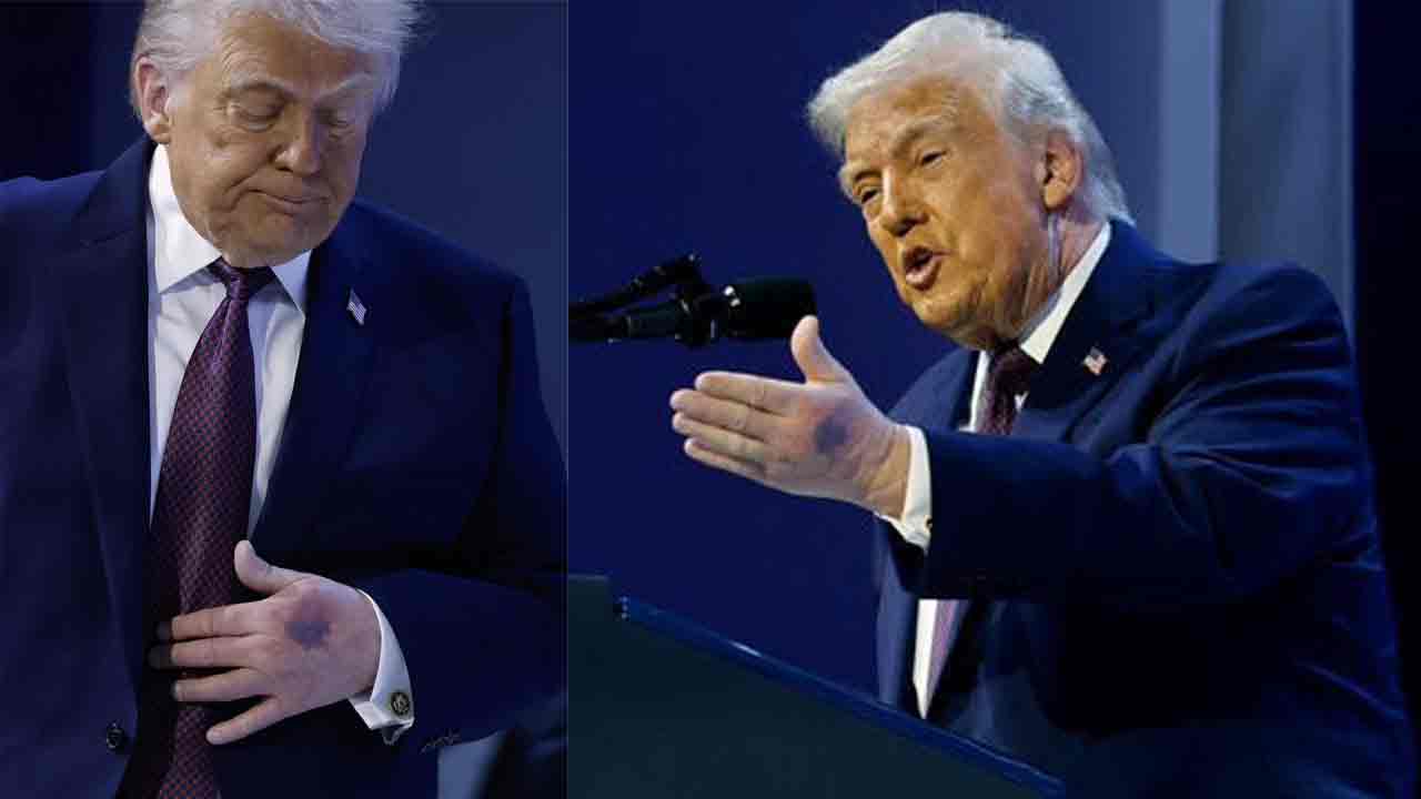 Donald Trump | ట్రంప్ చేతిపై ఆ గాయాలేంటి? అమెరికా అధ్యక్షుడి ఆరోగ్యంపై మళ్లీ ఆందోళనలు!