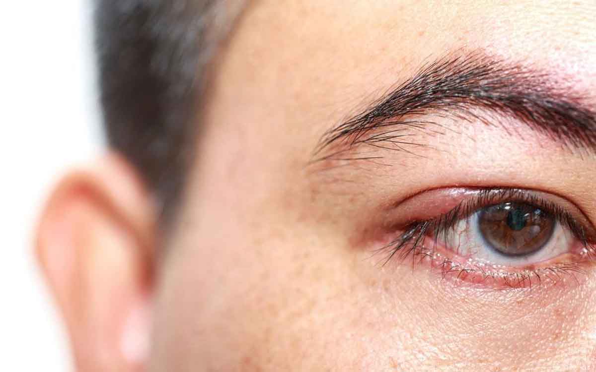 Kidney Failure | మీ క‌ళ్ల‌లో ఇలాంటి ల‌క్ష‌ణాలు క‌నిపిస్తున్నాయా..? అయితే మీ మూత్ర పిండాలు దెబ్బ తిన్నాయ‌ని అర్థం..!