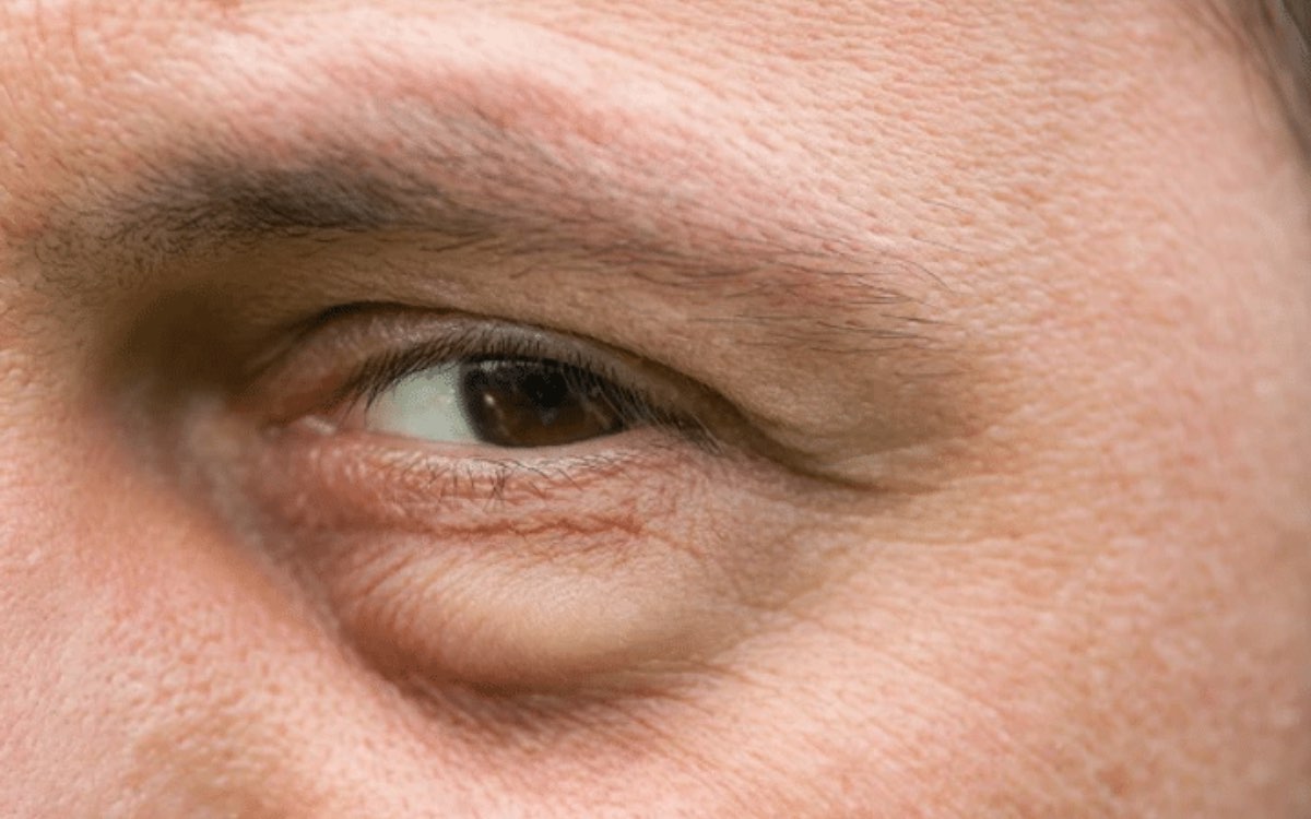 Eyes Swelling | క‌ళ్ల కింద వాపులు త‌గ్గించాలంటే.. ఇలా చేయండి..!