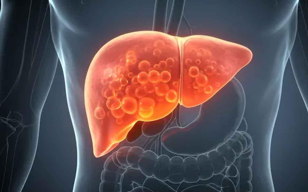 Fatty Liver | ఫ్యాటీ లివ‌ర్ స‌మ‌స్య‌తో బాధ‌ప‌డుతున్నారా..? అయితే ఏయే ఆహారాల‌ను తీసుకోకూడ‌దు..?