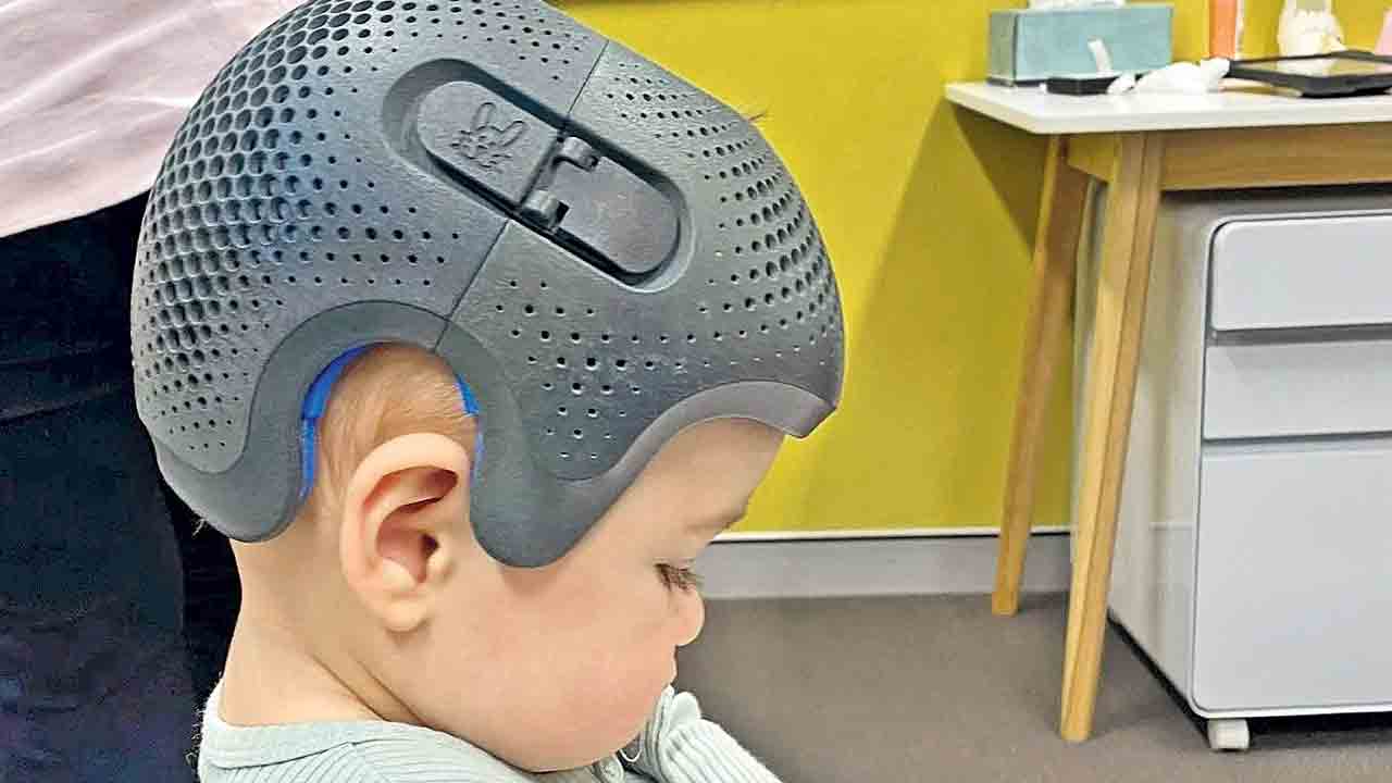 హెల్మెట్‌ థెరపీ అంటే?