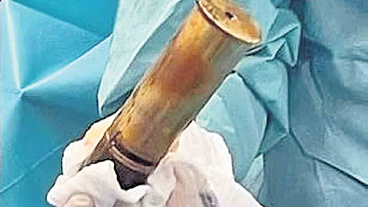 ఫ్రెంచ్‌ వ్యక్తి మలాశయంలో లైవ్‌ షెల్‌