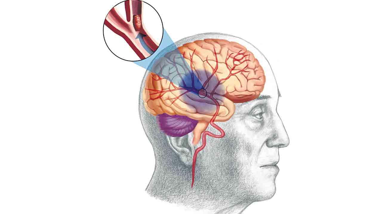 మెదడుకు వెతలు