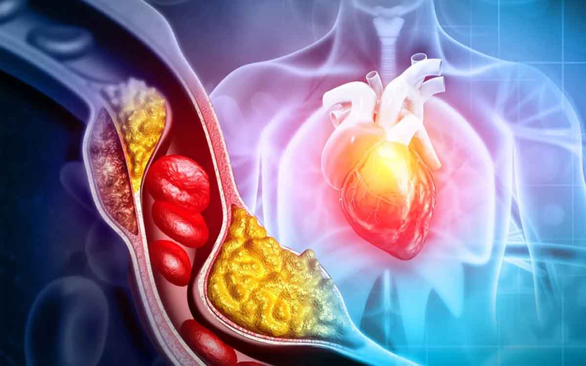 Arteries | ర‌క్త‌నాళాల్లో బ్లాక్స్ ఉన్నాయా..? ఈ ఆహారాల‌ను తీసుకుంటే మేలు జ‌రుగుతుంది..!