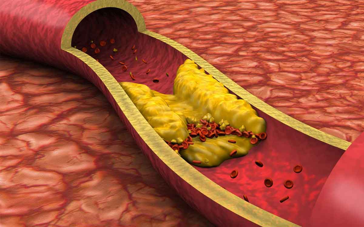 Arteries | ర‌క్త‌నాళాల్లో ఉండే బ్లాక్స్‌ను క‌రిగించ‌డానికి ఇంట్లోనే ఈ పానీయాల‌ను త‌యారు చేసి తాగండి..!