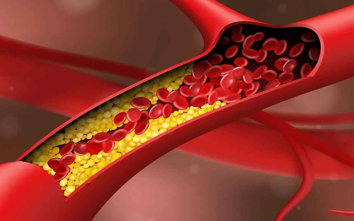 Arteries | ధ‌మ‌నుల ఆరోగ్యం మెరుగు ప‌డాలంటే.. వీటిని తీసుకోవాలి..!
