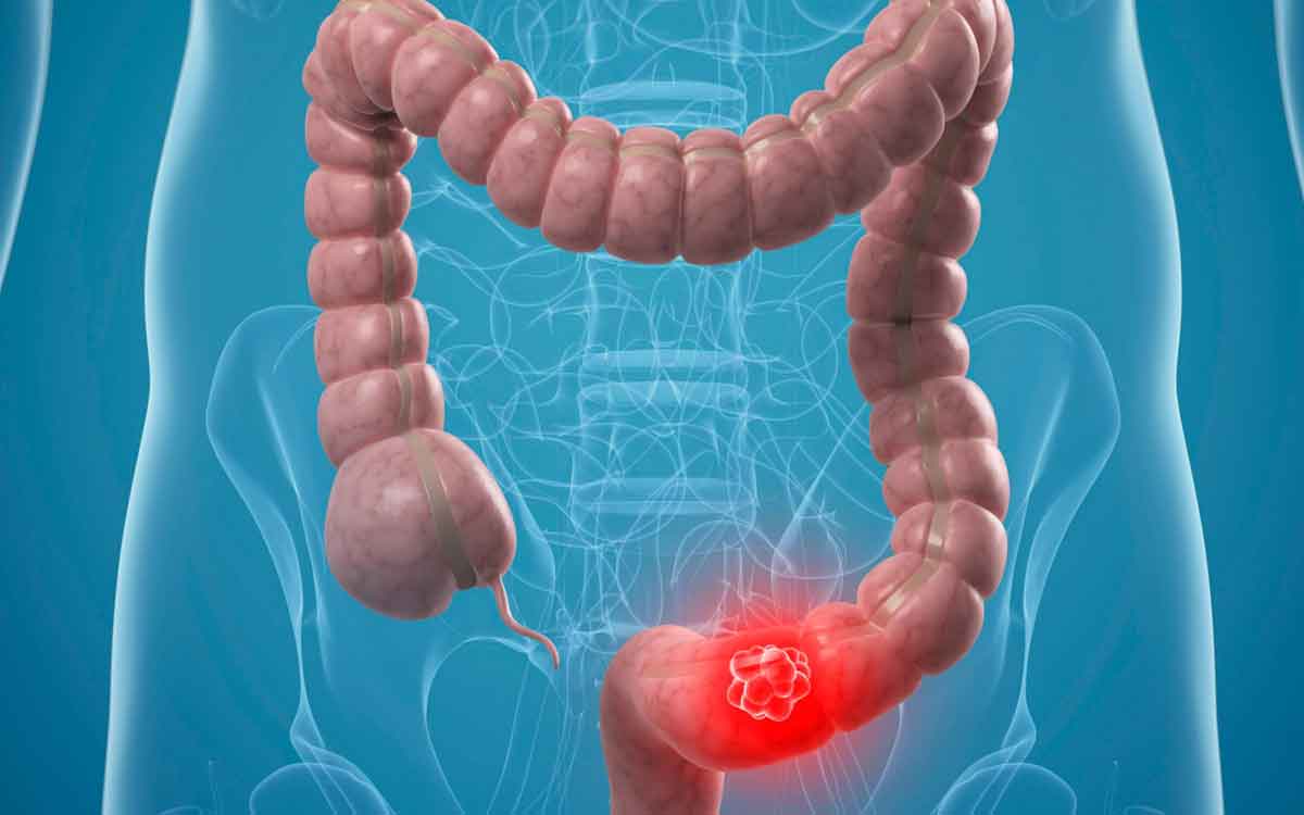 Colon Cancer Symptoms | పెద్ద పేగు క్యాన్స‌ర్ ఉంటే ఆరంభంలో క‌నిపించే ల‌క్ష‌ణాలు ఇవే.. జాగ్ర‌త్త ప‌డాల్సిందే..!