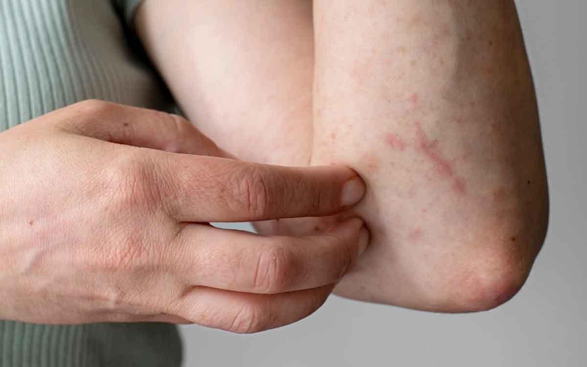 Diabetes Symptoms On Skin | మీ చ‌ర్మంపై ఈ సంకేతాలు క‌నిపిస్తుంటే.. డ‌యాబెటిస్ ఉన్న‌ట్లే నిర్ల‌క్ష్యం చేయ‌కండి..!