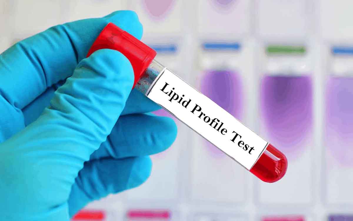 High Cholesterol Symptoms | కొలెస్ట్రాల్ అధికంగా ఉంటే క‌నిపించే ల‌క్ష‌ణాలు ఇవే.. ఏ ప‌రీక్ష‌లు చేయించుకోవాలంటే..?