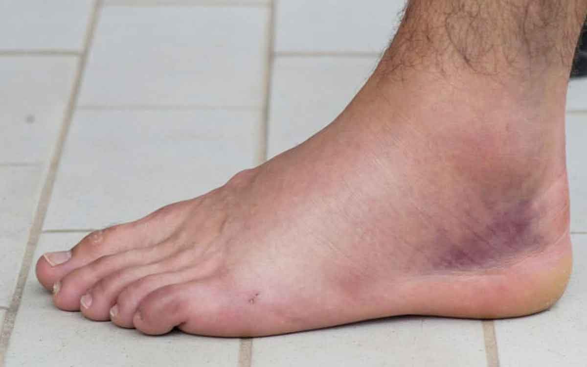 Ankle Swelling | పాదాల వ‌ద్ద వాపులు త‌ర‌చూ వ‌స్తున్నాయా..? అందుకు కార‌ణాలేంటి.. ఏం చేయాలి..?