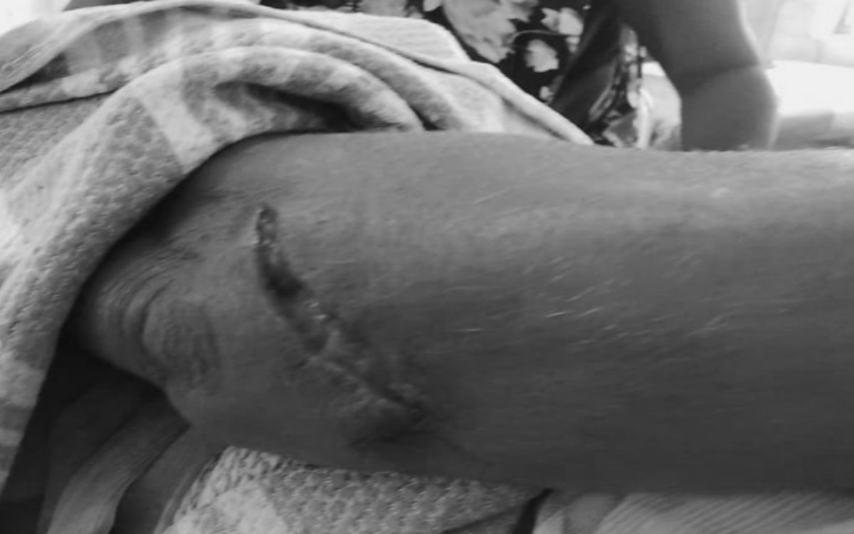 చెర్వుఅన్నారంలో కోతుల బీభత్సం.. మహిళకు తీవ్రగాయాలు