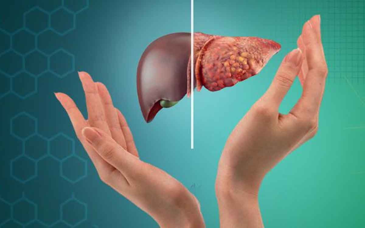 Fatty Liver | వేగంగా పెరుగుతున్న ఫ్యాటీ లివ‌ర్ స‌మ‌స్య‌.. ఆహారంలో మార్పులు చేసుకోవ‌డం అవ‌స‌రం..