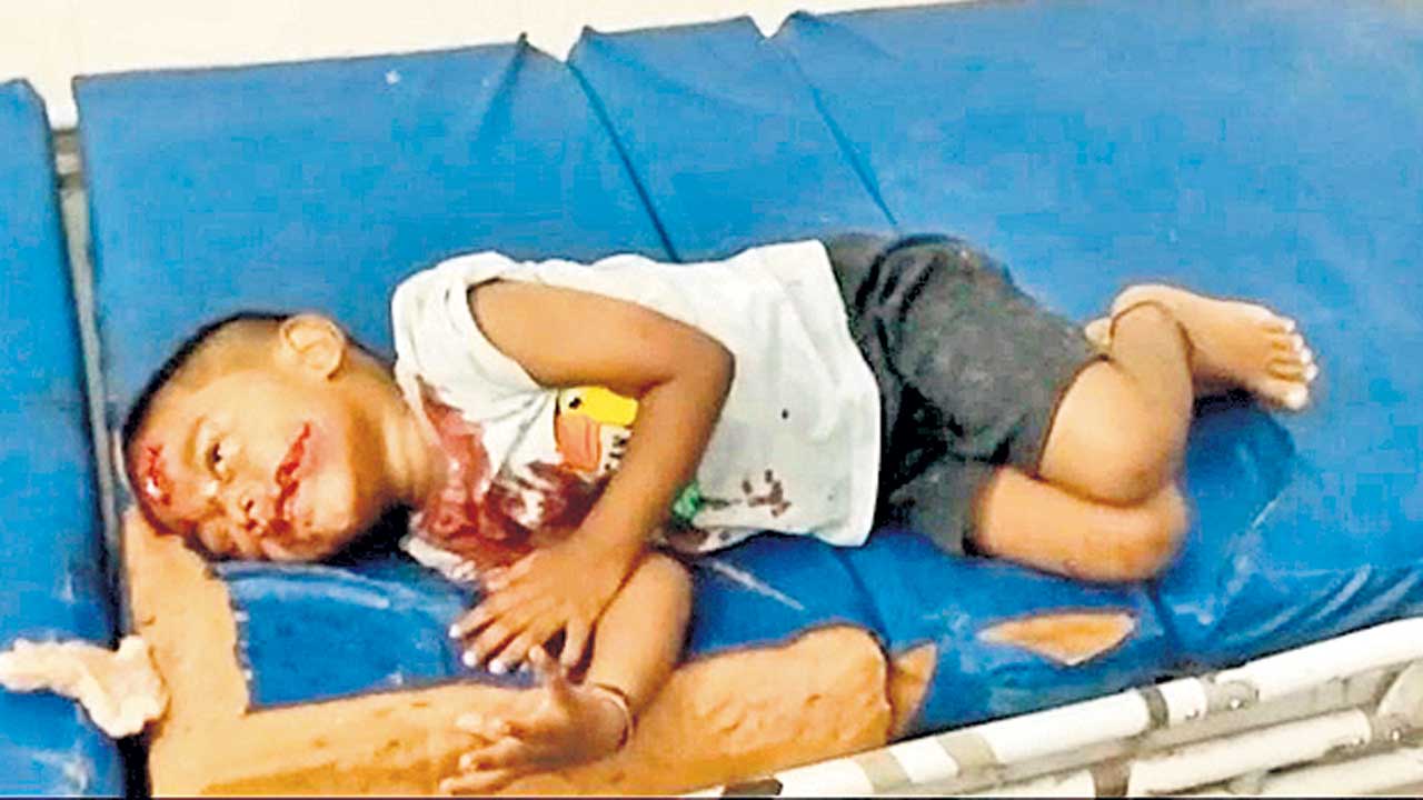 బాలుడి కన్నుగుడ్డు పెకిలించిన వీధి కుక్కలు