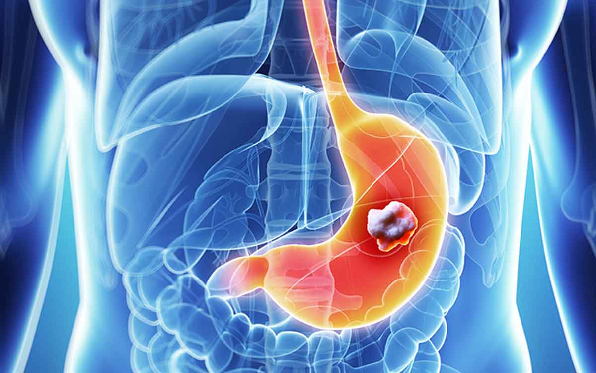 Stomach Cancer | జీర్ణాశ‌య క్యాన్స‌ర్ ల‌క్ష‌ణాలు ఇవే.. ఇవి క‌నిపిస్తే ఏమాత్రం నిర్ల‌క్ష్యం చేయ‌కండి..