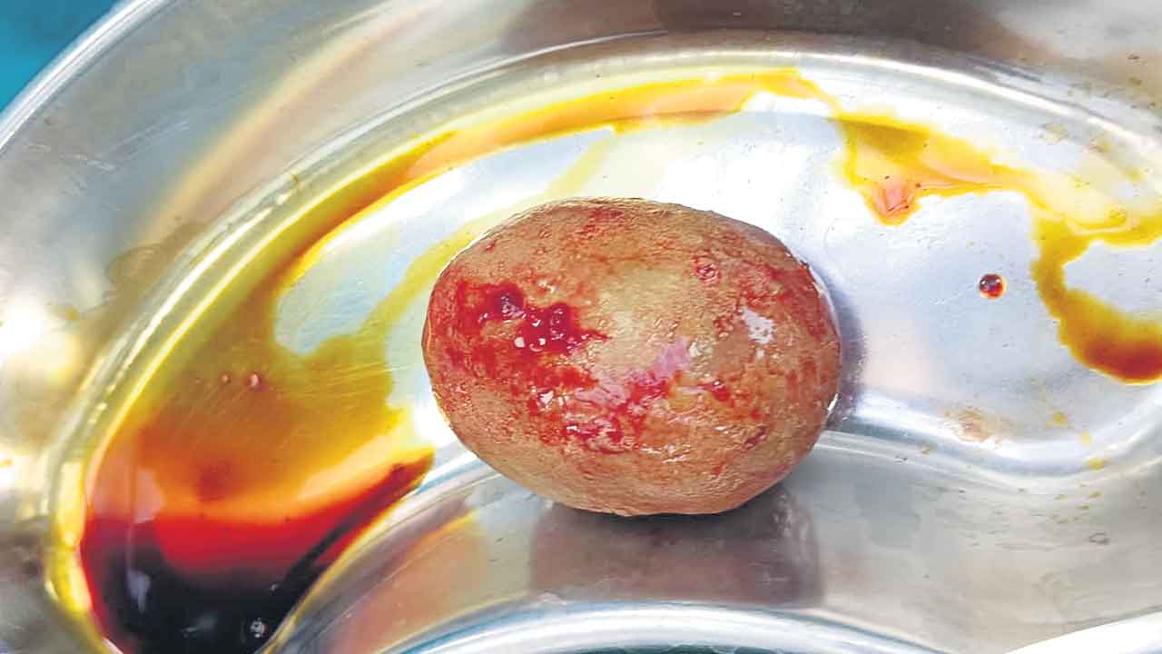 బాలుడి కిడ్నీలో 200 గ్రాముల రాయి తొలగింపు