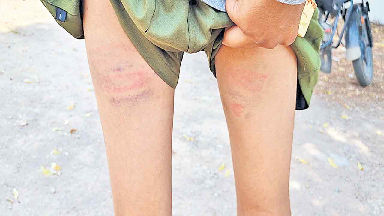 విద్యార్థులను వాతలు వచ్చేలా కొట్టిన ప్రిన్సిపాల్‌.. అలంపూర్‌లోని ఫూలే గురుకుల పాఠశాలలో ఘటన