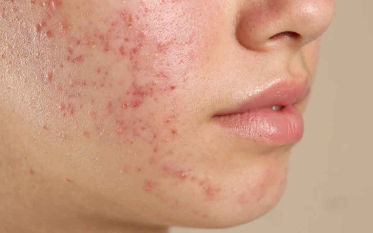 Acne | మొటిమ‌లు అస‌లు ఎందుకు వ‌స్తాయి..? అవి ఏర్ప‌డేందుకు కార‌ణాలు ఏమిటి..?