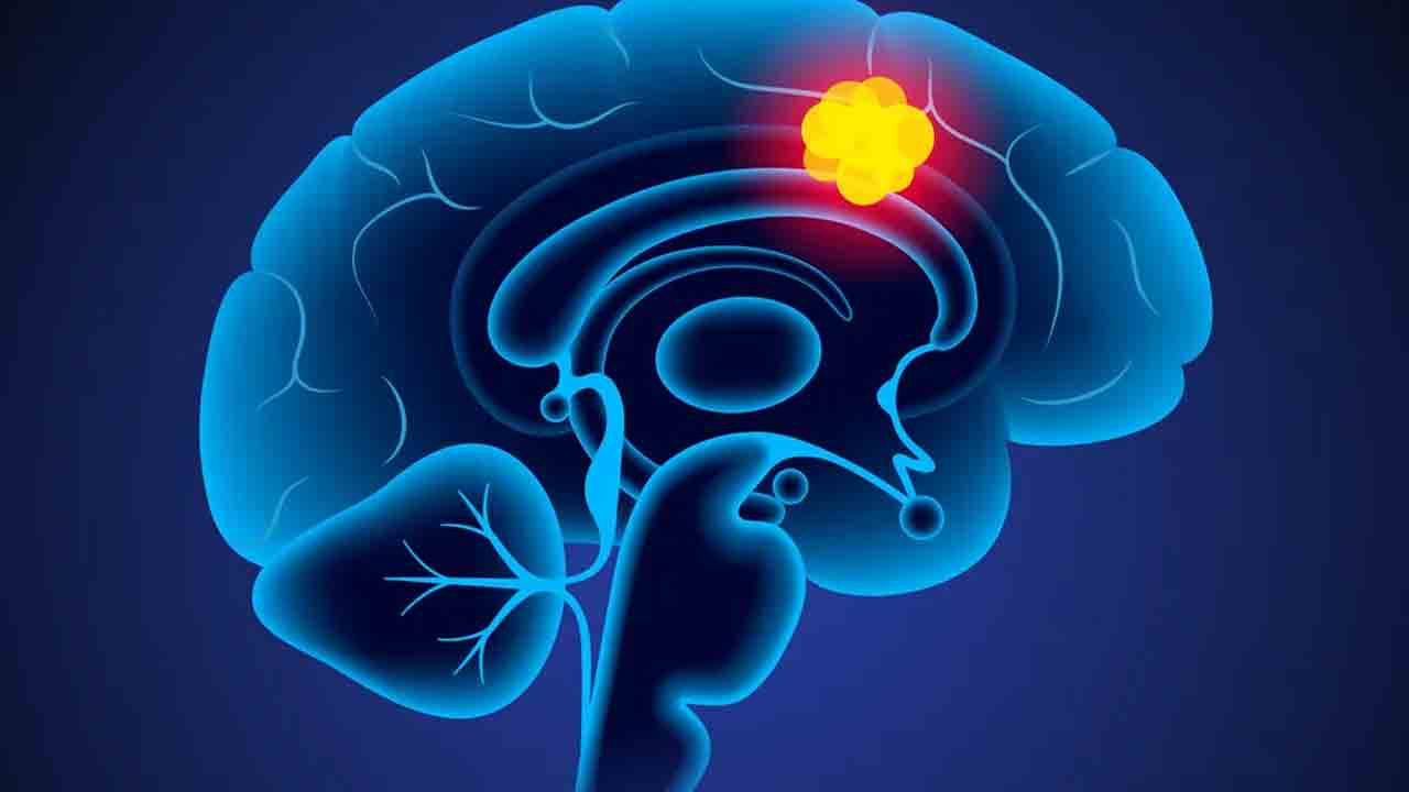 5 రోజుల్లో బ్రెయిన్‌ ట్యూమర్‌ మటుమాయం!