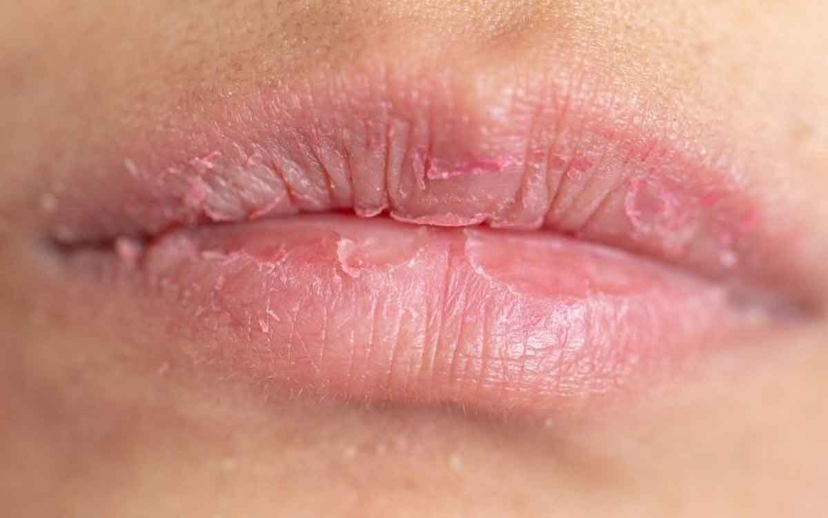 Dry Lips | పెద‌వులు తర‌చూ పొడిబారుతున్నాయా.. అయితే ఈ చిట్కాల‌ను పాటించండి..