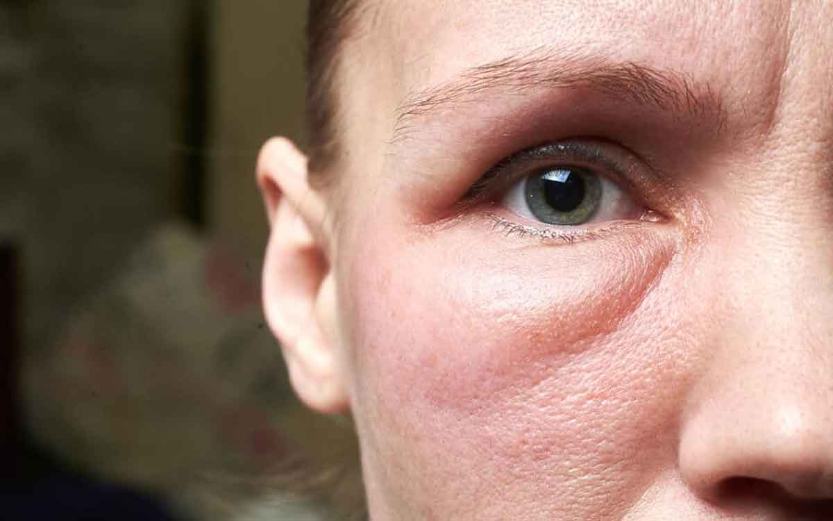 Face Inflammation | ముఖంలో వాపులు వ‌చ్చి అంద‌విహీనంగా క‌నిపిస్తుందా.. అలా ఎందుకు జ‌రుగుతుంది.. త‌గ్గాలంటే ఏం చేయాలి..?