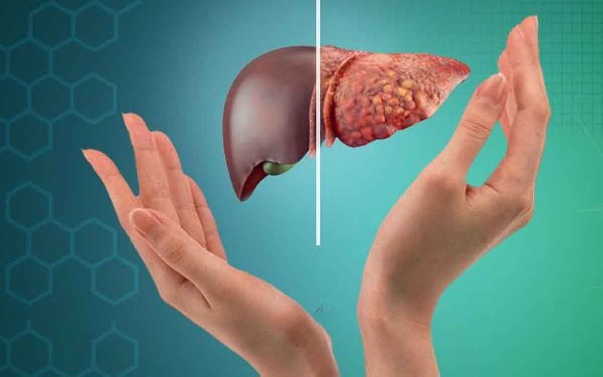 Fatty Liver | ఫ్యాటీ లివ‌ర్ ఉన్న వారు ఈ నూనెల‌ను వాడాలి.. వాటి విష‌యంలో రాజీ ప‌డ‌వ‌ద్దు..