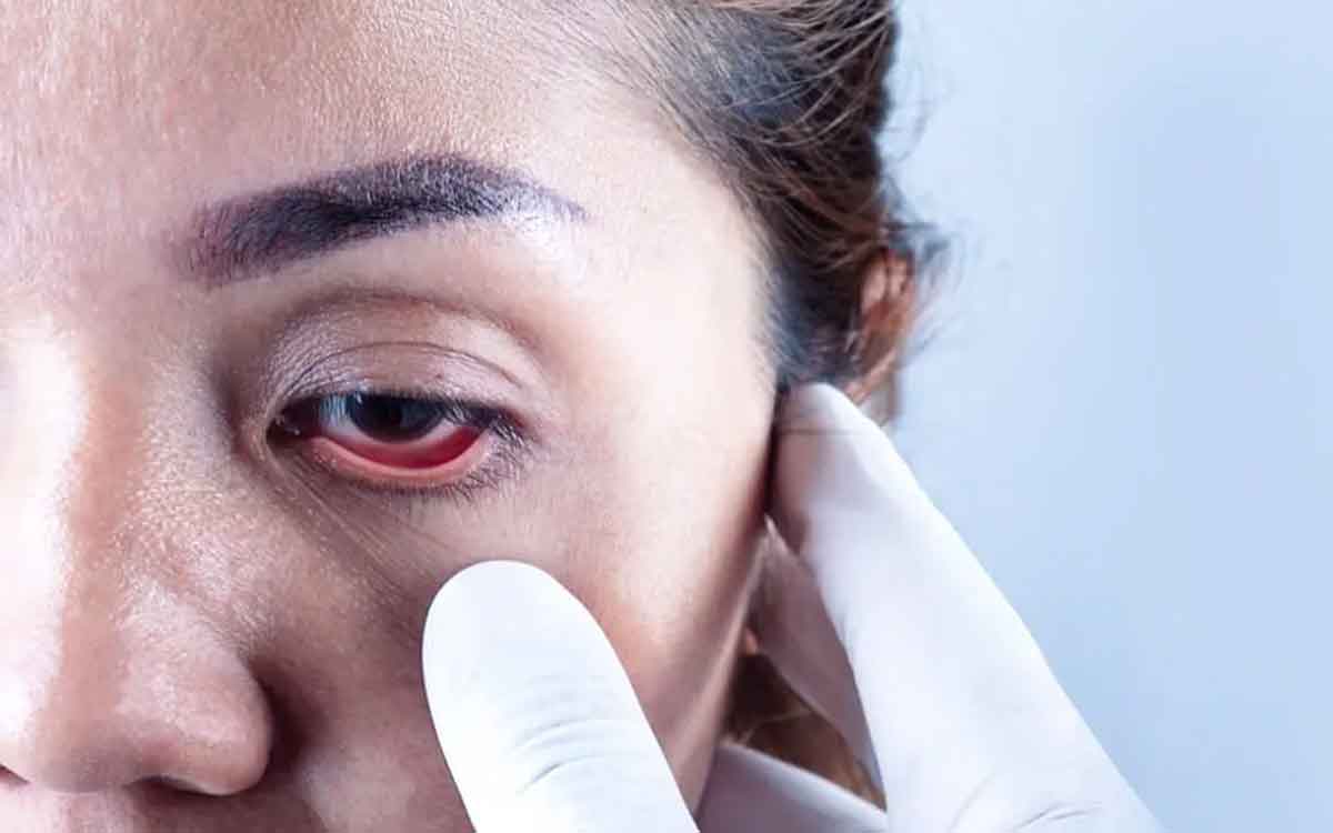 Glaucoma | గ్లోకోమా ల‌క్ష‌ణాలు ఇవే.. ముందుగా స్పందించ‌క‌పోతే శాశ్వ‌త అంధ‌త్వం వ‌చ్చే అవ‌కాశం..