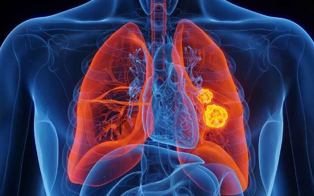 Lung Cancer | కోవిడ్ నుంచి కోలుకున్న వారిలో పెరుగుతున్న లంగ్ క్యాన్స‌ర్ కేసులు.. అప్ర‌మ‌త్తంగా ఉండాల‌ని నిపుణుల సూచ‌న‌..