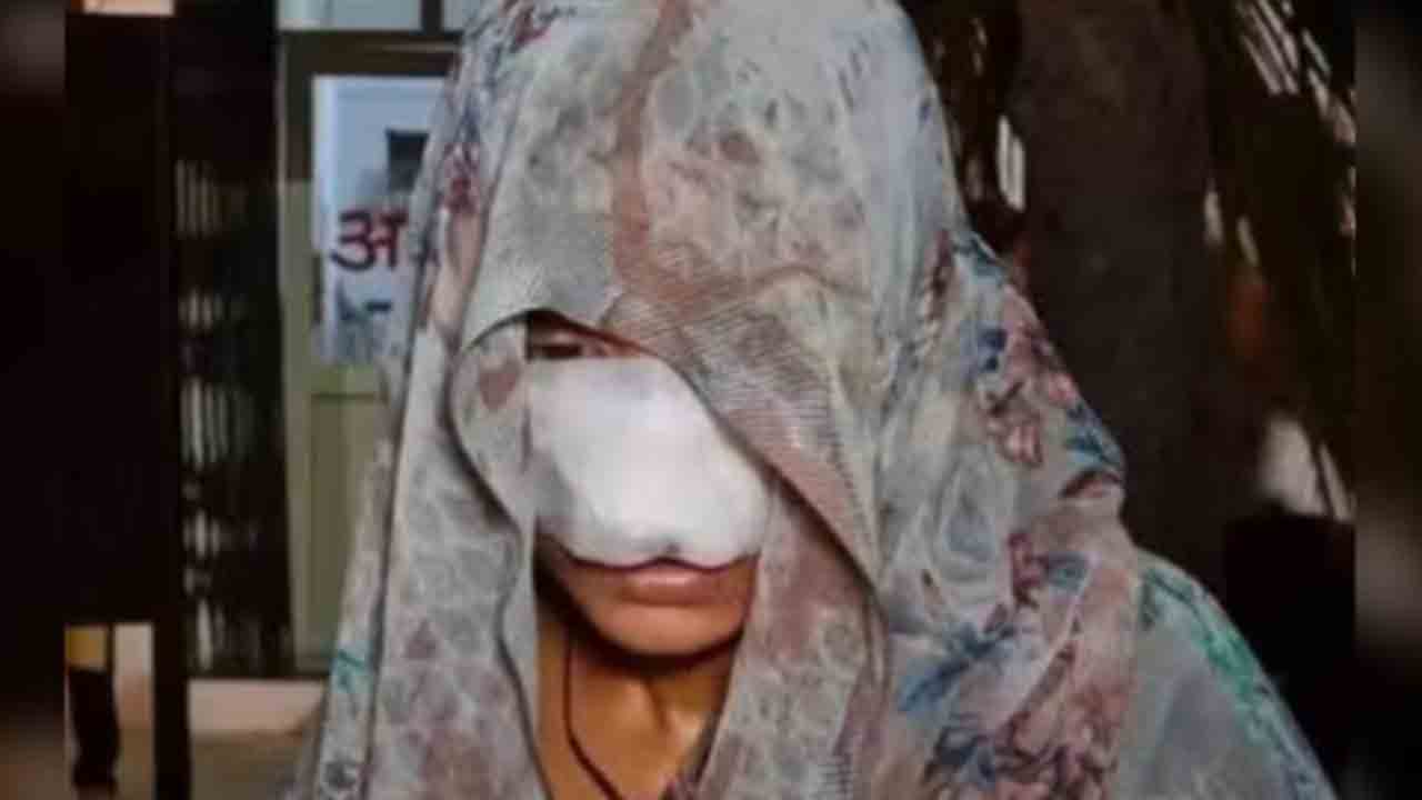 man bites wife’s nose | గొడవ నేపథ్యంలో.. భార్య ముక్కు, చెంప కొరికిన భర్త