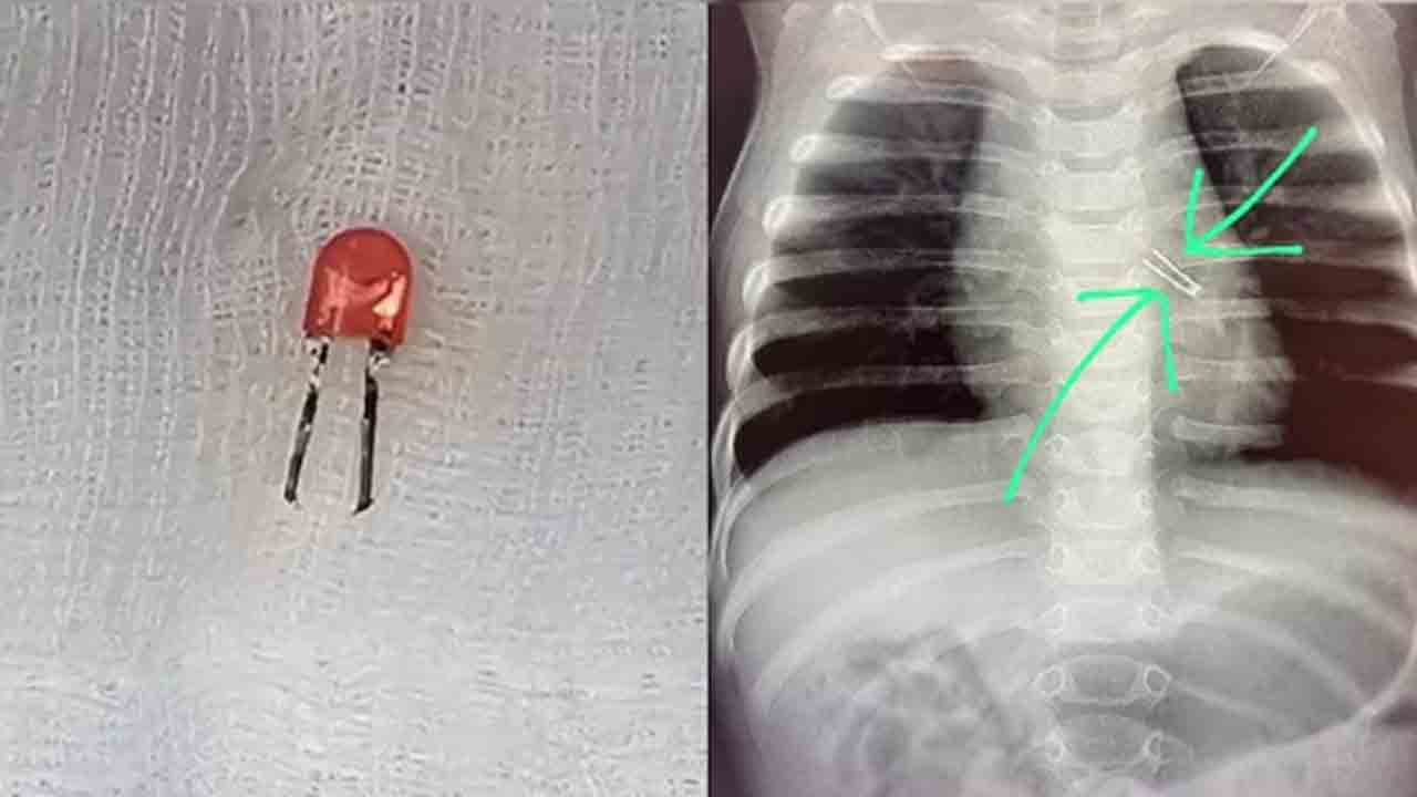 LED Bulb in Baby’s Lung | చిన్నారి ఊపిరితిత్తుల్లో ఇరుక్కున్న ఎల్‌ఈడీ.. సర్జరీ ద్వారా తొలగించిన ఆర్మీ వైద్యులు