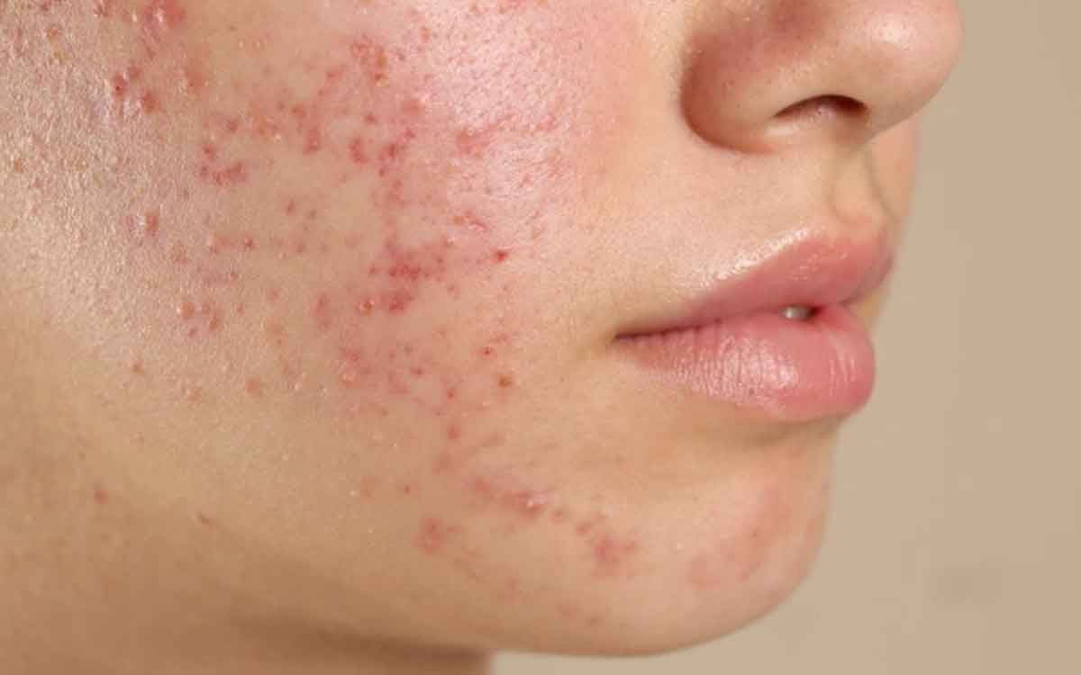 Acne | మ‌హిళ‌ల్లో అధికంగా వ‌చ్చే మొటిమ‌ల స‌మ‌స్య‌కు కార‌ణాలు ఇవే.. ఏం చేయాలంటే..?