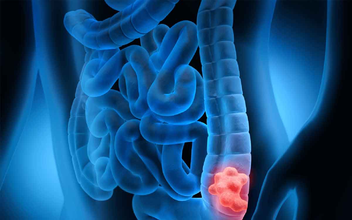 Colon Cancer | యువ‌త‌లోనూ అధిక‌మ‌వుతున్న పెద్ద పేగు క్యాన్స‌ర్‌.. అప్ర‌మ‌త్తంగా ఉండ‌క‌పోతే ముప్పేన‌ని వైద్యుల హెచ్చ‌రిక‌..