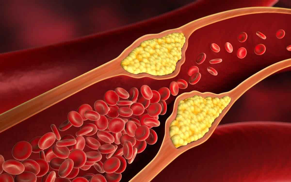 High Cholesterol | ఈ ల‌క్ష‌ణాలు క‌నిపిస్తుంటే కొలెస్ట్రాల్ అధికంగా ఉన్న‌ట్లే.. ఏం చేయాలంటే..