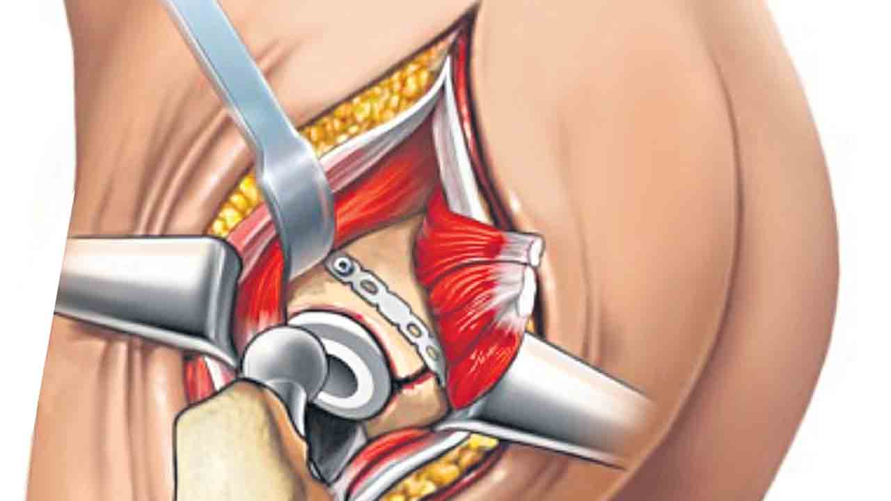 Hip Replacement Surgery