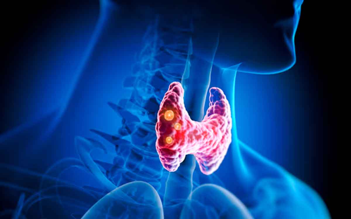 Thyroid Problems | థైరాయిడ్ స‌మ‌స్య‌లు ఉన్న‌వారు ఎలాంటి ఆహారాల‌ను తీసుకోవాలి.. వేటిని మానేయాలి..?
